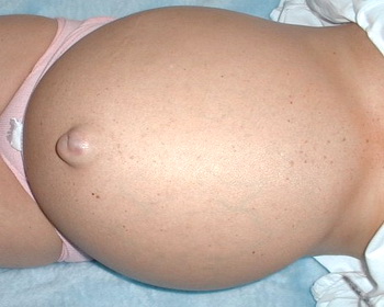 Асцит при беременности